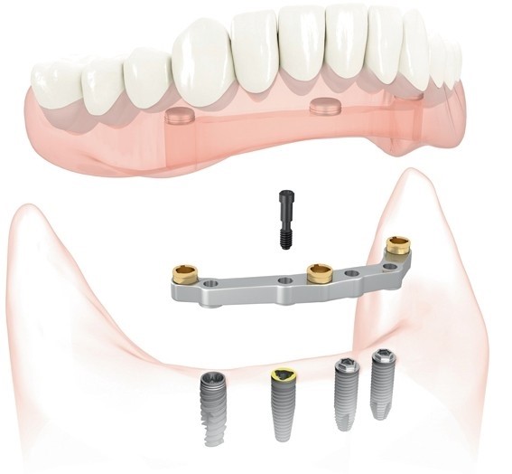 Flexible Partial Dentures Exeland WI 54835